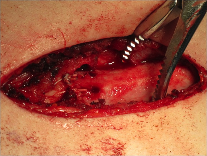 SCJ Suture Fixation